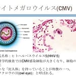 腸管CMV感染症が見つかった